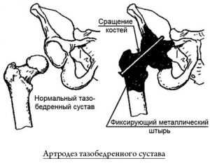 Как можно сидеть после операции на тазобедренном суставе фото