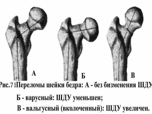 Где находится вертельная кость бедра фото