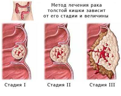 Лечение сигмовидной кишки препараты схема лечение