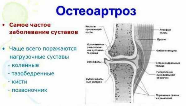 Гонартроз коленного сустава 1 степени фото