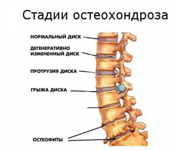 Остеохондроз презентация неврология