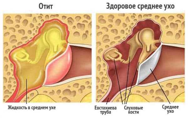 Двусторонний диффузный катаральный эндобронхит на фоне атрофии слизистой