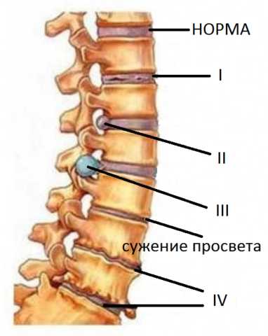 Дореопатия заболевание на фоне поясничного остеохондроза