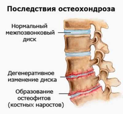 Дореопатия заболевание на фоне поясничного остеохондроза