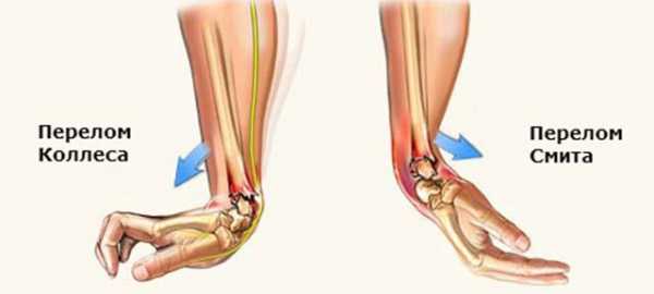 Перелом руки фото