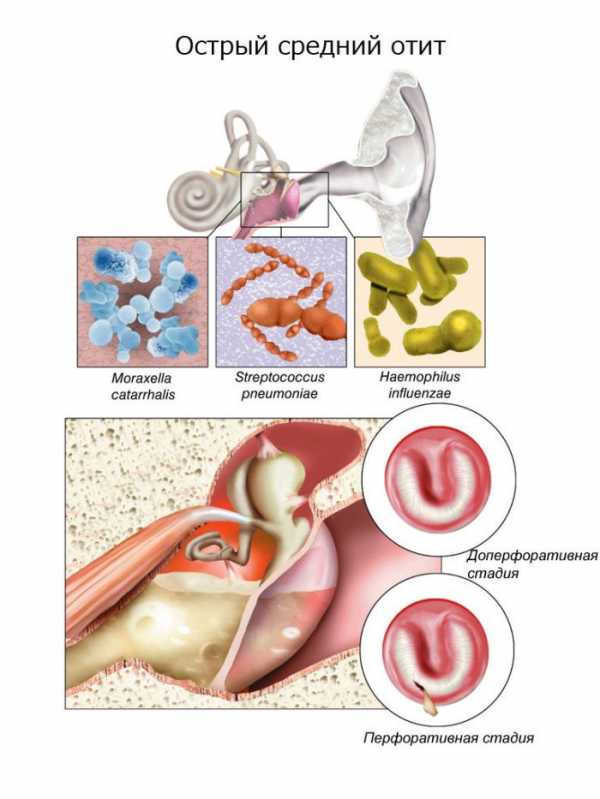 Гнойный отит среднего уха фото