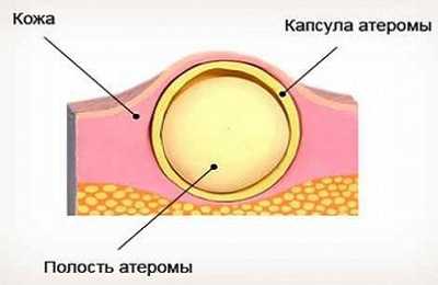 Отложение солей фото