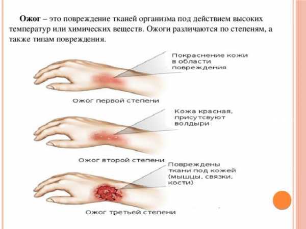 Ожоги 3 й степени фото