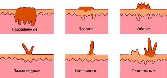 Папилломы на теле лечение фото