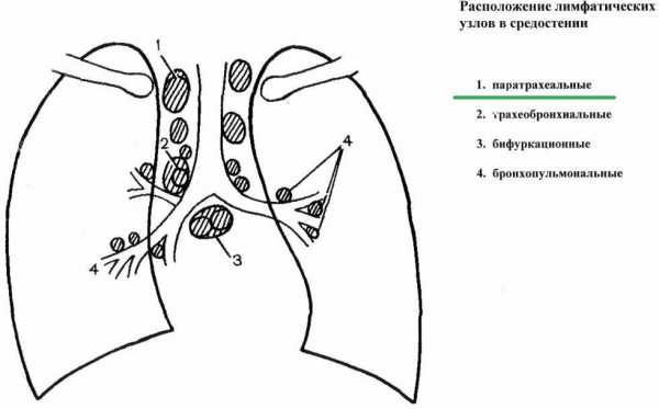 Парааортальные лимфоузлы где находятся фото