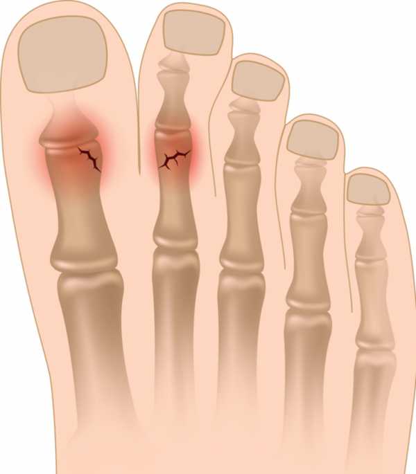 Перелом фаланги большого пальца ноги фото