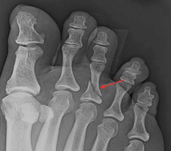 Перелом фаланги пальца на ноге фото
