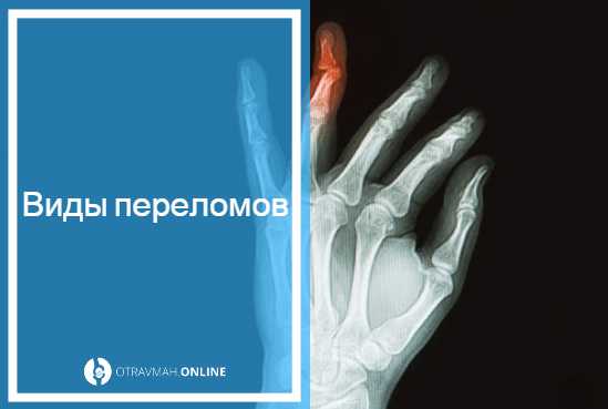 Перелом большого пальца на руке симптомы фото