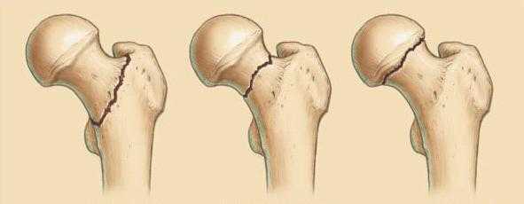 Шейка бедра где находится у человека фото перелом у пожилых людей симптомы