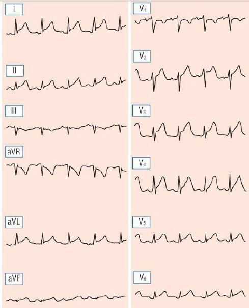 Перикардит экг картина