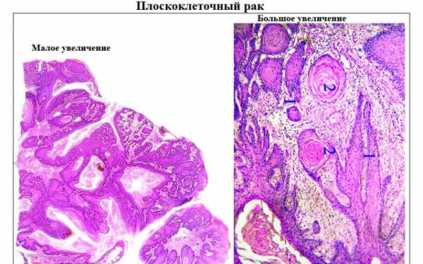 Плоскоклеточный неороговевающий рак фото