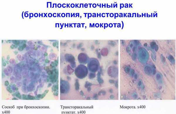 Рак легкого 4 стадия фото как выглядит