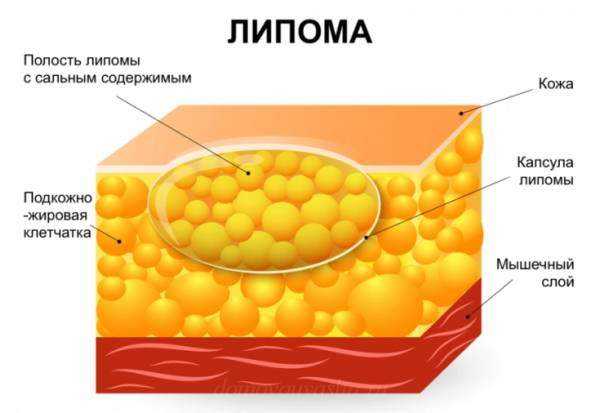 Подкожный жировик на спине фото