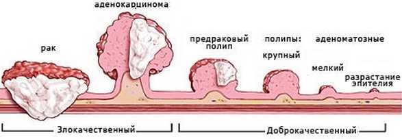 Полипы в желудке фото