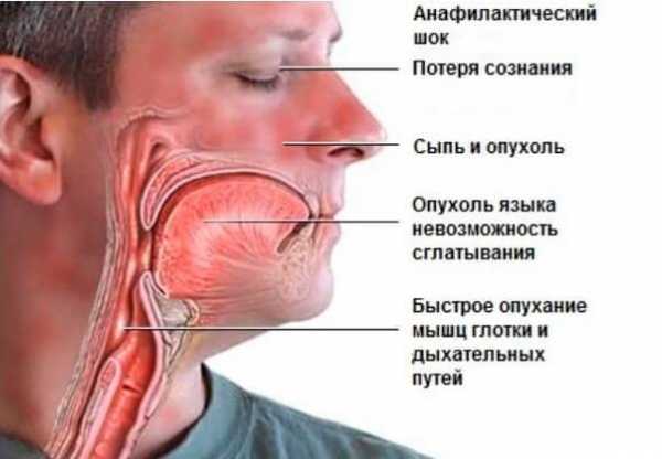 Опухает язычок в горле после алкоголя