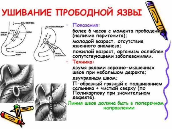 Что может подтвердить пенетрацию язвы по клинической картине верно все кроме одного