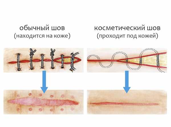 Нагноение шва после аппендицита фото