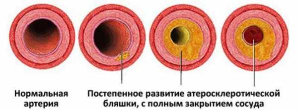 Обширный инфаркт фото