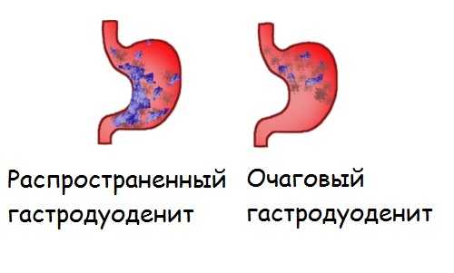 Гастродуоденит карта вызова