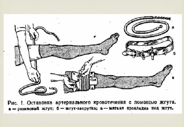 Остановка артериального кровотечения картинки