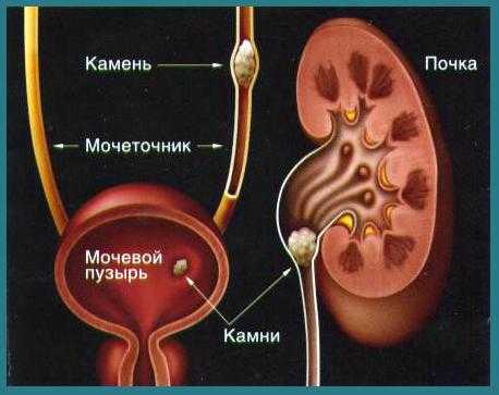 Кровь в стуле при простатите