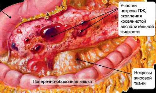 Боль в поджелудочной железе фото
