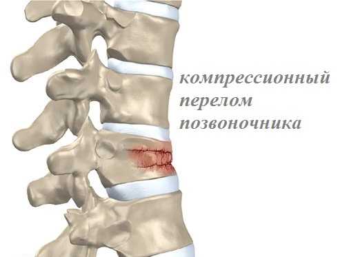 Карта вызова смп перелом позвоночника