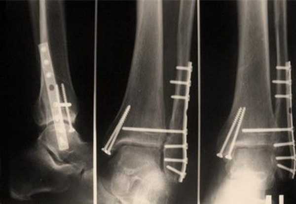 Картинка перелом лодыжки