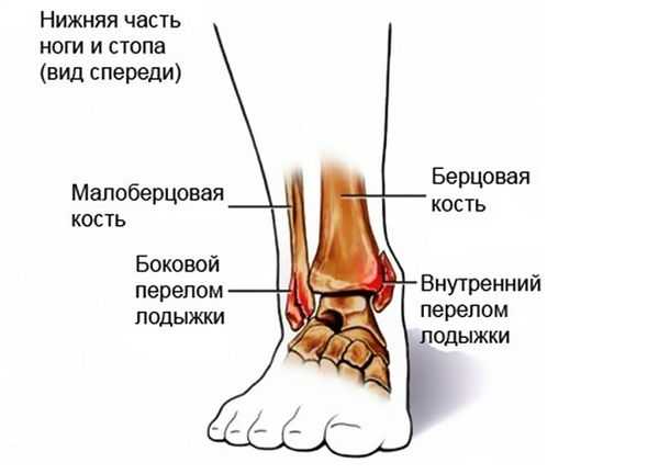 Перелом голени картинки