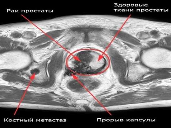 Как выглядит рак простаты у мужчин на фото