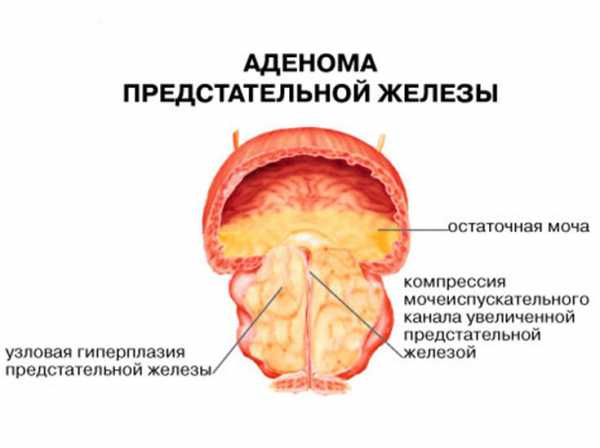 Где находится предстательная железа у мужчин в картинках