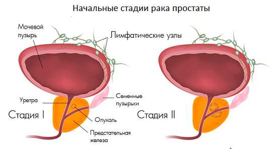 Как выглядит рак простаты у мужчин на фото