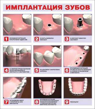 Установка импланта зуба этапы с фото