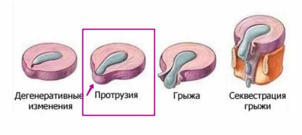 Что такое протрузия позвоночника поясничного отдела фото