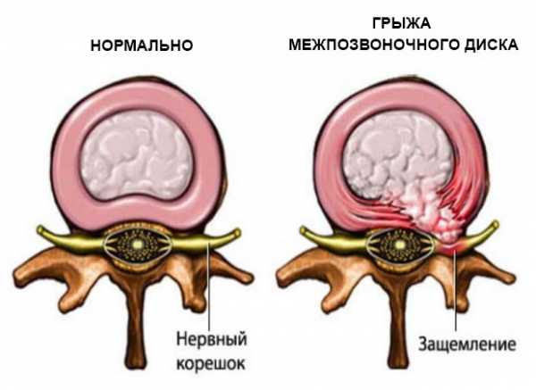 При протрузии дисков поясничного отдела какая физическая нагрузка разрешена