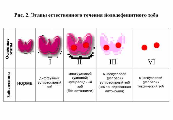 Папиллярный рак щитовидной железы прогноз после операции сколько лет жизни