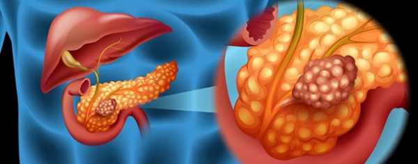 Стол при раке поджелудочной железы