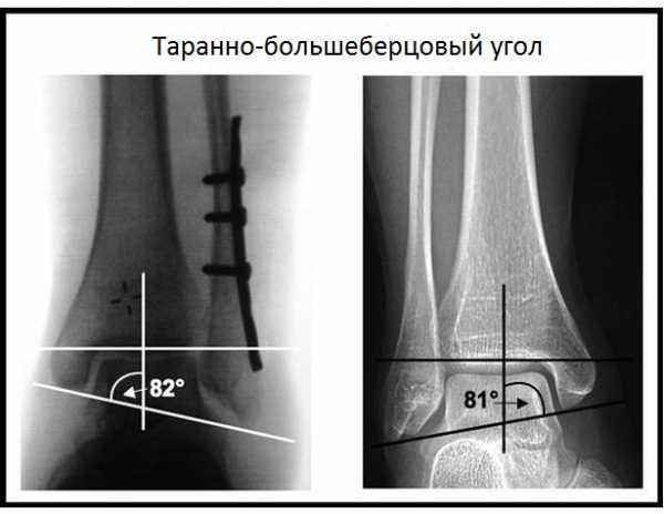 Лодыжка у человека фото