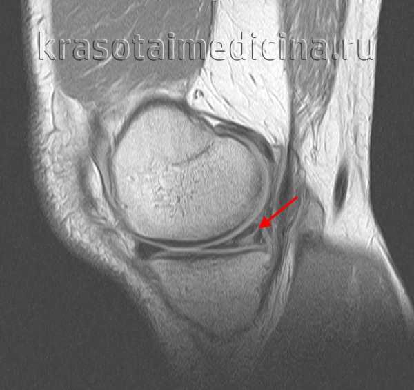 Задний рог медиального мениска коленного сустава фото