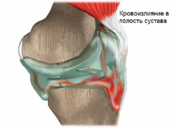 Мениск коленного сустава картинки