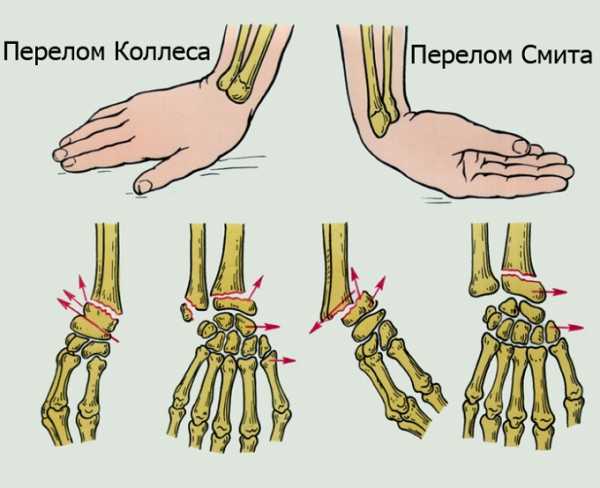 План реабилитации после перелома голени