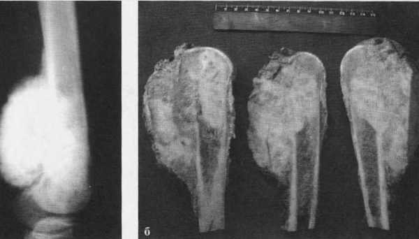 Саркома кости симптомы фото