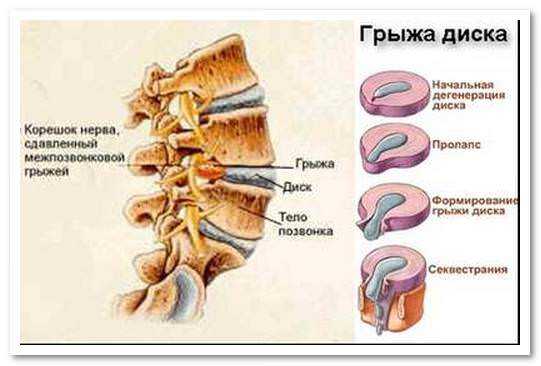 Позвоночная грыжа симптомы картинки