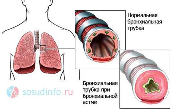 Сердечная астма презентация