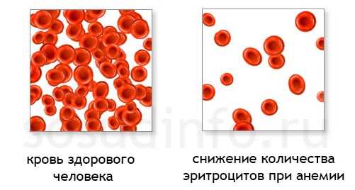 Серповидно клеточная анемия картинки